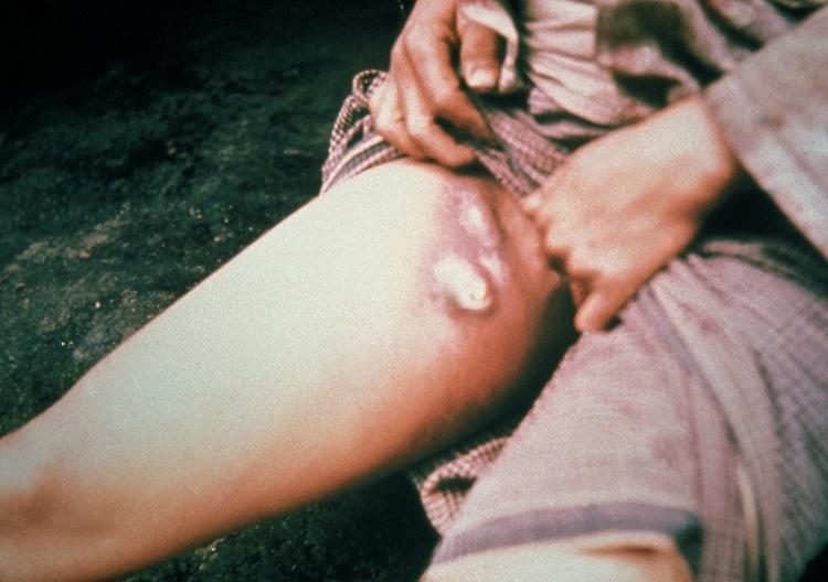 بیماری طاعون خیارکی چیست و چقدر خطرناک و کشنده است؟